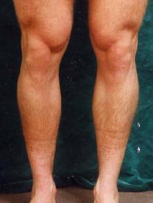 Men's Calf Augmentation 