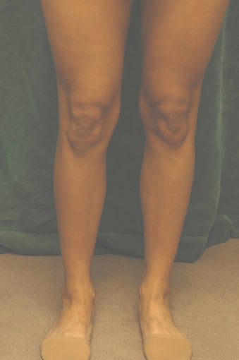Men's Calf Augmentation  