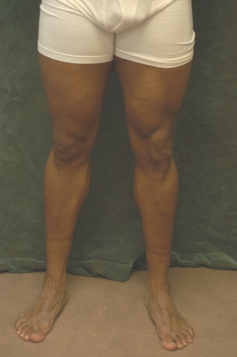 Men's Calf Augmentation 