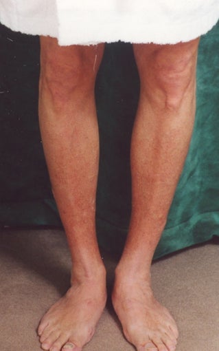 Men's Calf Augmentation  