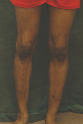 Men's Calf Augmentation 