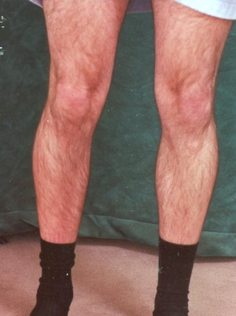 Men's Calf Augmentation 