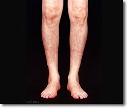 Calf Implant