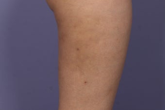Cellulaze