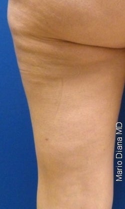 Cellulaze