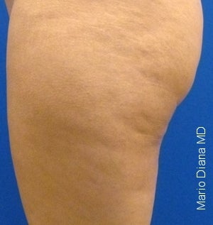 Cellulaze