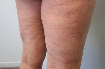 Cellulaze