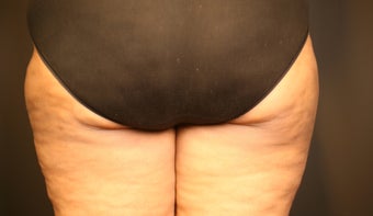 Cellulite Treatment