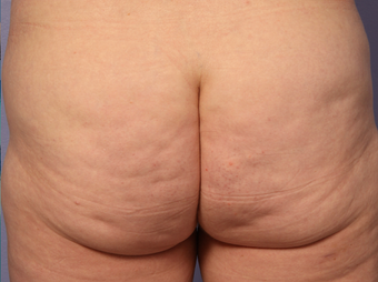 Cellulaze