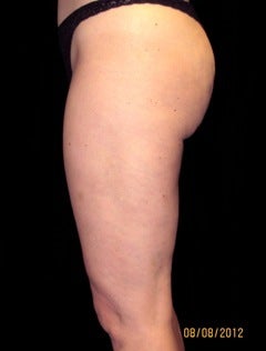 Cellulaze