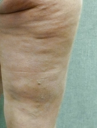 Cellulaze