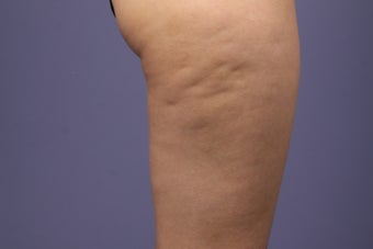 Cellulaze