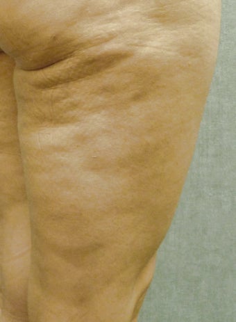 Cellulaze
