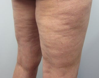 Cellulaze
