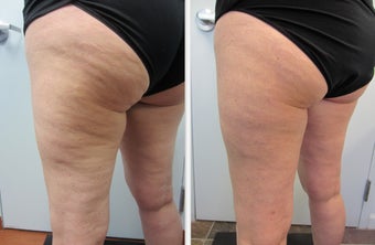 Cellulaze Laser Cellulite Reduction