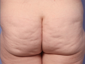 Cellulaze