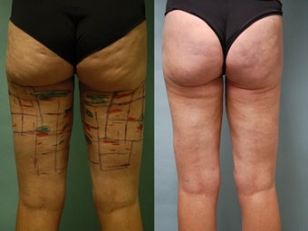 Cellulaze anti-cellulite treatment of buttocks and thighs