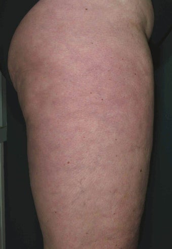 Cellulite treatment