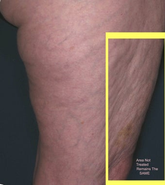 Cellulite treatment