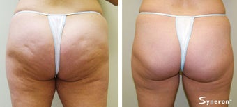 Velashape, after 5 treatments