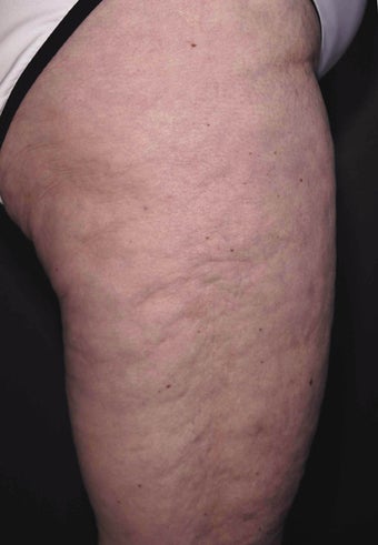 Cellulite treatment
