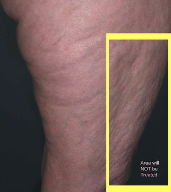 Cellulite treatment