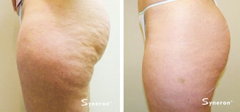 Velashape, after 5 treatments