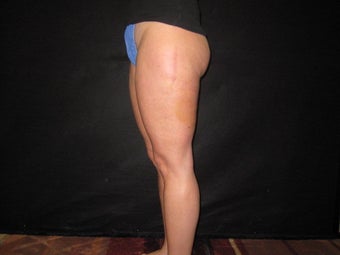 Cellulite Treatment