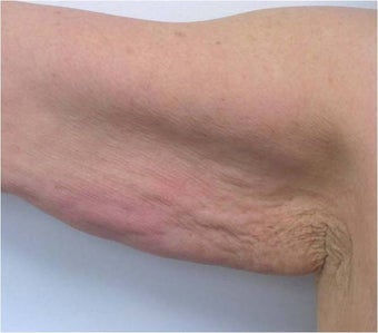 Accent for Cellulite Treatment