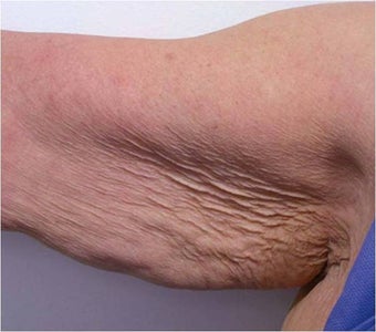 Accent for Cellulite Treatment