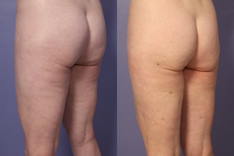 Cellulaze
