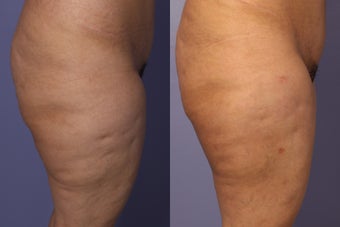 Cellulaze
