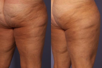 Cellulaze