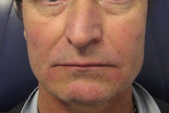 Radiesse Cheeks, below corners of mouth and marrionettes