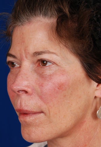 Radiesse Cheek Augmentation