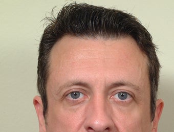 Cheek implants