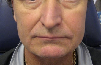 Radiesse Cheeks, below corners of mouth and marrionettes