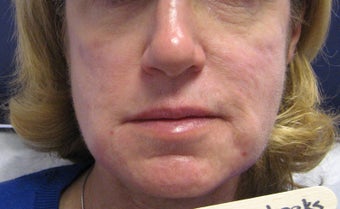 Radiesse Cheeks, below corners of mouth, marrionettes and jawline