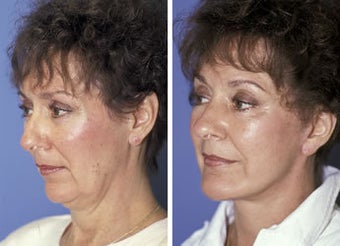 Face lift with a chin implant