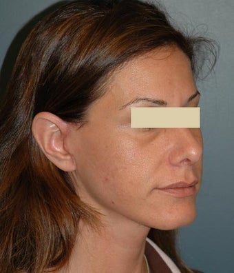 cheek lift