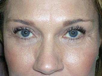 Cheek Lift