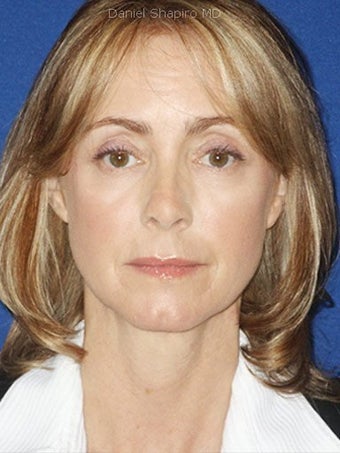 Cheeklift (Minifacelift), Bilateral Upper Blepharoplasty, Periorbital TCA Chemical Peel, Soft Tissue Filler to Nasolabial Folds 