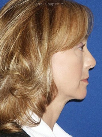 Cheeklift (Minifacelift), Bilateral Upper Blepharoplasty, Periorbital TCA Chemical Peel, Soft Tissue Filler to Nasolabial Folds