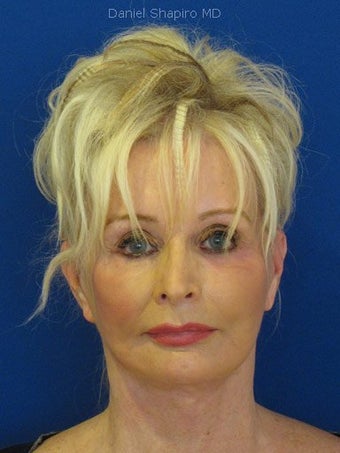 Cheeklift (minifacelift) with TCA chemical peel to the lower eyelids performed in the office under oral sedation with local anes