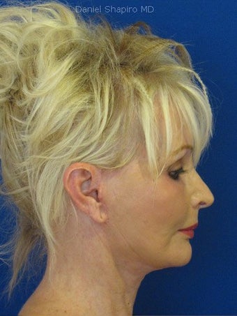 Cheeklift (minifacelift) with TCA chemical peel to the lower eyelids performed in the office under oral sedation with local anes