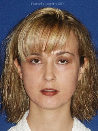 Cheeklift (Minifacelift) with TCA chemical peel to the lower eyelids, performed comfortably in the office.