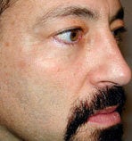 Mid facelift with tear trough implant