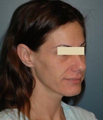 cheek lift