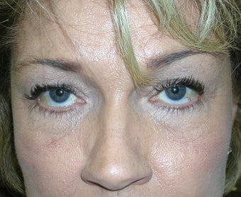 Cheek Lift