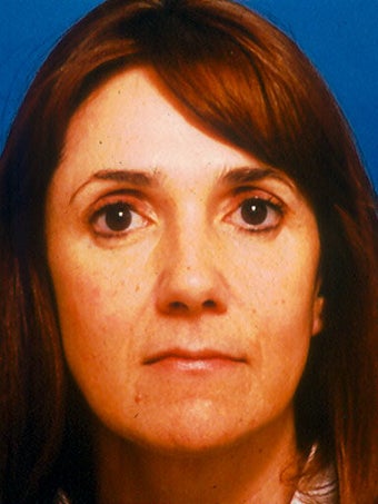  Cheeklift (Minifacelift), Lateral Temporal Browlift, Bilateral Lower Blepahroplasty. 